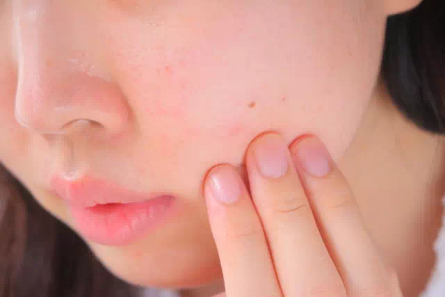 ほくろ(黒子)のイメージ画像