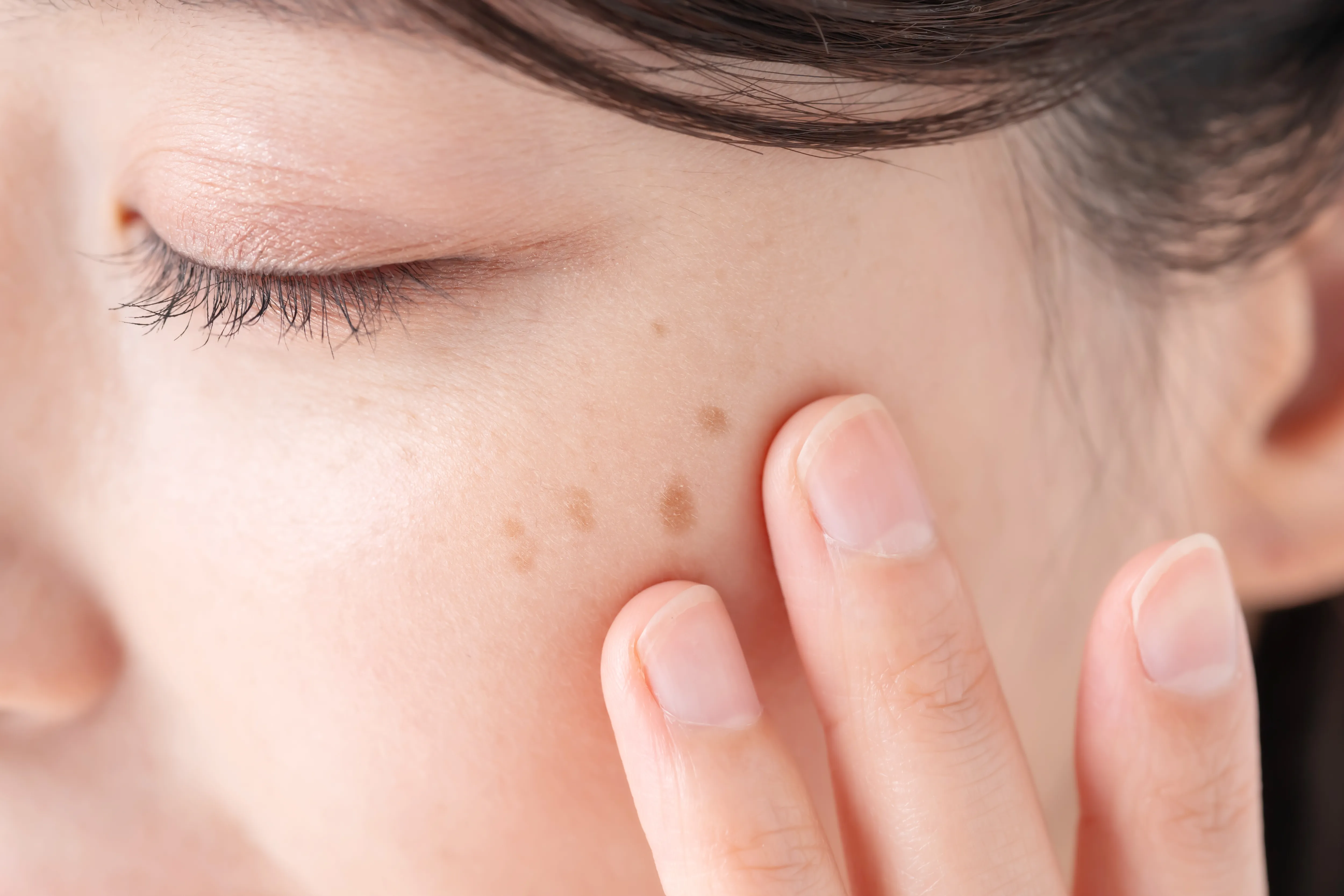 シミのイメージ画像