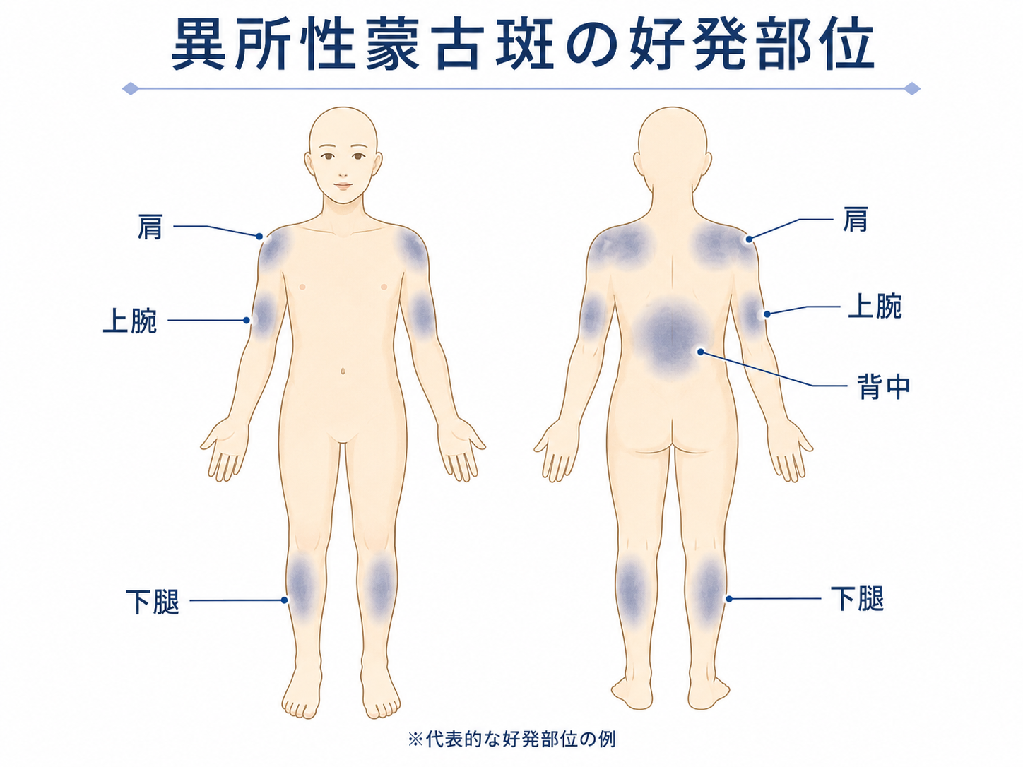 異所性蒙古斑の好発部位
